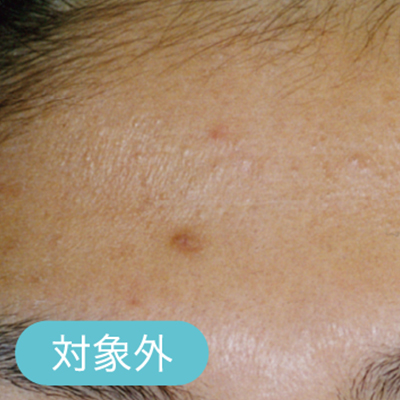 ニキビ跡の色素沈着