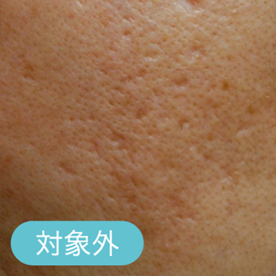 ニキビ跡の凹み